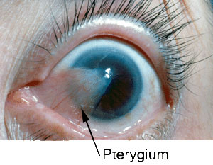 pterygium1