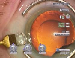 behandeling van cataract - incisie