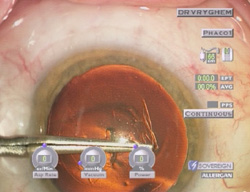 behandeling van cataract - capsulorhexis