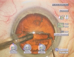 behandeling van cataract - phako-emulsificatie
