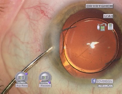 behandeling van cataract - lens in de kapselzak, wonde zonder hechtingen