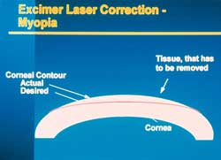 Excimer laser voor myopie