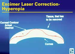 Excimer laser voor hyperopia