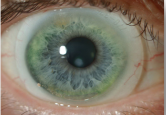 sclerale contactlens op het oog